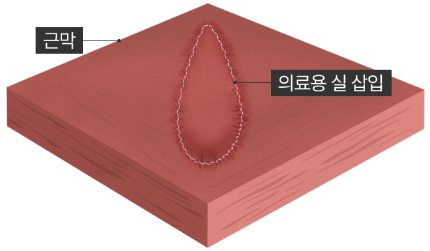 근막 기둥