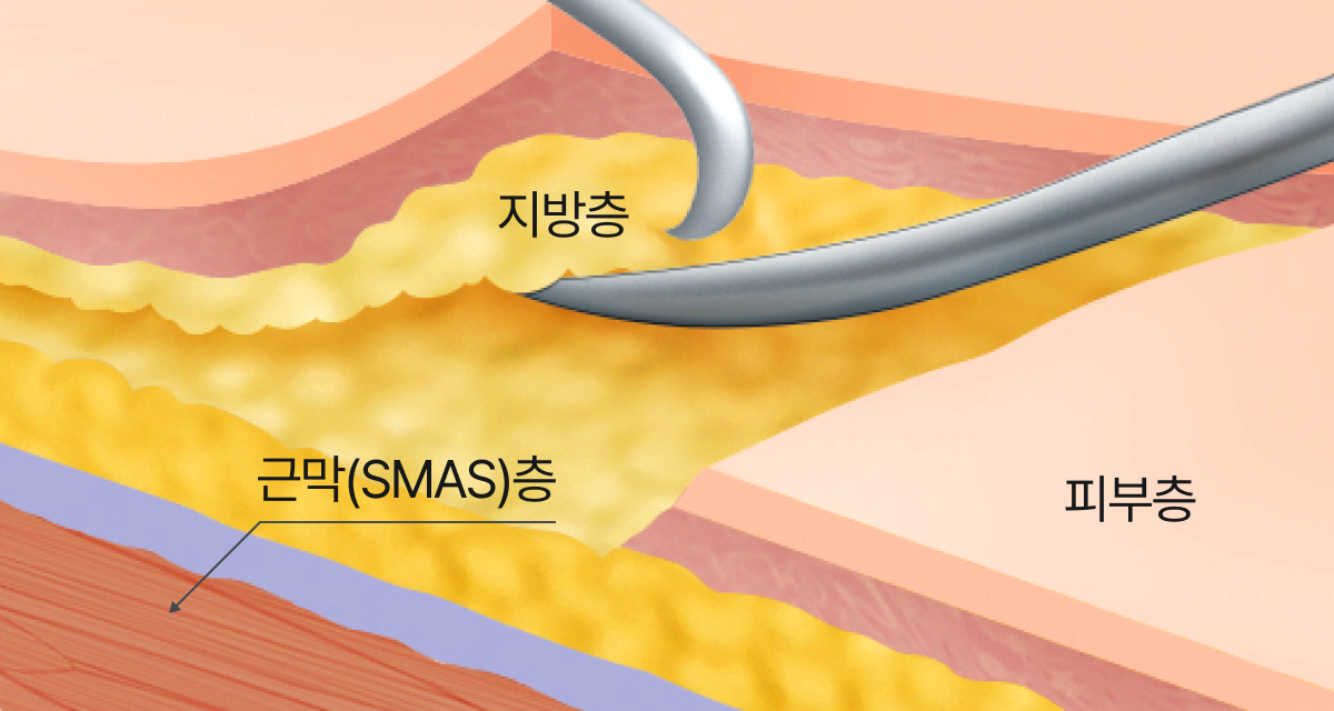 지방층을 당기는 잘못된 박리